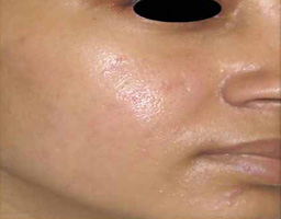 Acne Scar Removal