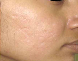 Acne Scar Removal