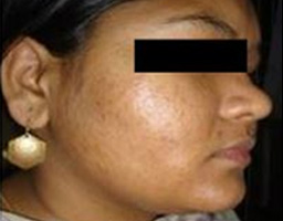 Acne Scar Removal