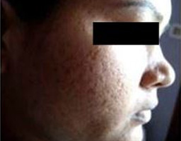 Acne Scar Removal