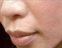 Acne Scar Removal