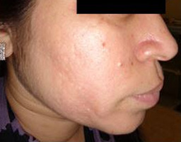Acne Scar Removal