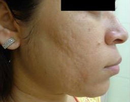 Acne Scar Removal