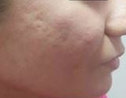 Acne Scar Removal