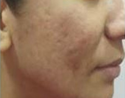 Acne Scar Removal