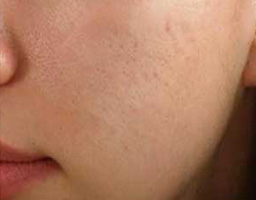 Acne Scar Removal