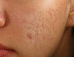 Acne Scar Removal