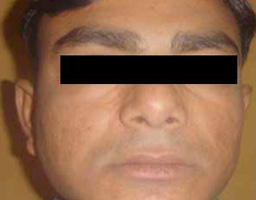 Acne Scar Removal