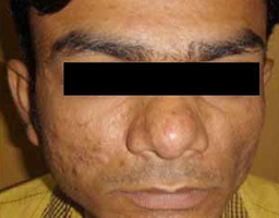 Acne Scar Removal