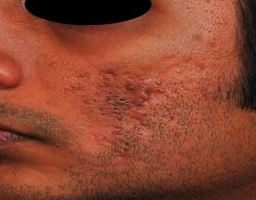 Acne Scar Removal