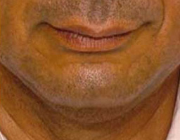 Anti Aging