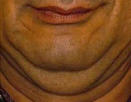 Anti Aging