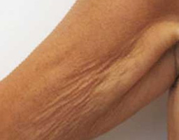 Anti Aging