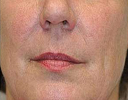 Anti Aging