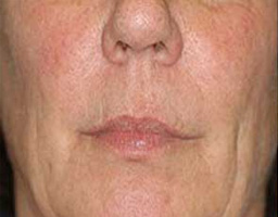 Anti Aging