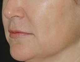 Anti Aging
