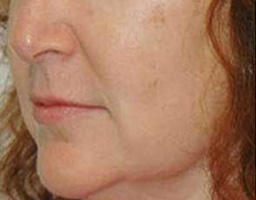 Anti Aging