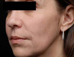 Anti Aging