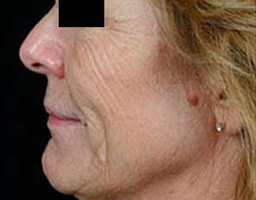 Anti Aging