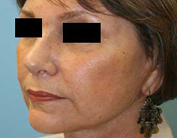 Anti Aging