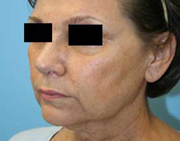 Anti Aging