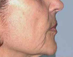 Anti Aging