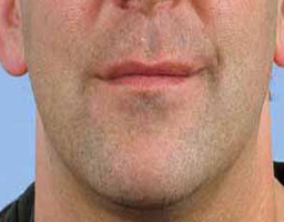 Anti Aging