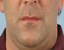 Anti Aging