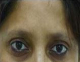 Botox Treatment