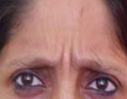 Botox Treatment