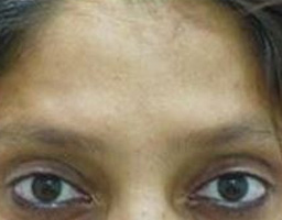 Botox Treatment