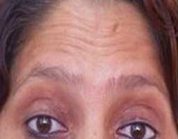 Botox Treatment
