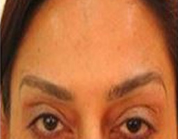 Botox Treatment