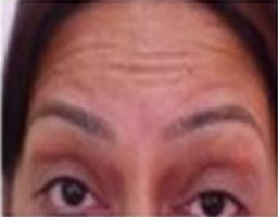 Botox Treatment