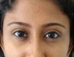 Botox Treatment
