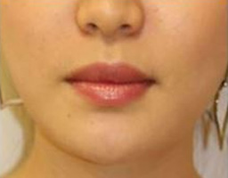 Botox Treatment