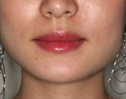 Botox Treatment