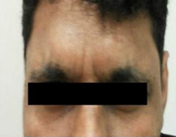 Botox Treatment