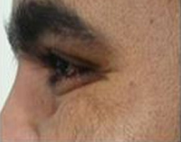 Botox Treatment