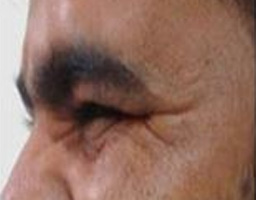 Botox Treatment