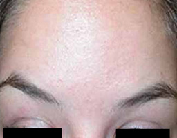 Botox Treatment