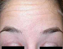 Botox Treatment