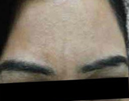 Botox Treatment