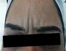 Botox Treatment