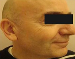 Botox Treatment