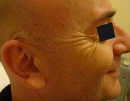 Botox Treatment