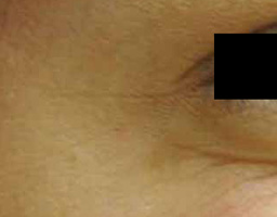 Botox Treatment