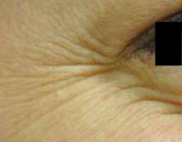 Botox Treatment