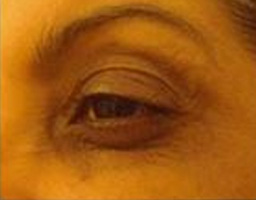 Botox Treatment