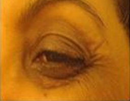 Botox Treatment